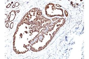 Formalin-fixed, paraffin-embedded human Breast Carcinoma stained with HSP60 Monoclonal Antibody (LK1) (HSPD1 antibody)