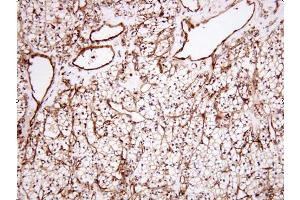 Paraffin embedded sections of human renal cell carcinoma tissue were incubated with anti-human Clusterin (1:100) for 2 hours at room temperature. (Clusterin antibody)