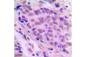 Immunohistochemical analysis of MEN staining in human breast cancer formalin fixed paraffin embedded tissue section. (MEN (Center) antibody)