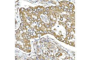 Immunohistochemistry of paraffin-embedded human lung cancer using Calumenin Rabbit mAb (ABIN7266050) at dilution of 1:25 (40x lens). (CALU antibody)