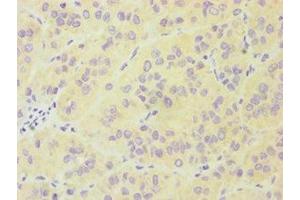 Immunohistochemistry of paraffin-embedded human liver cancer using ABIN7174019 at dilution of 1:100 (FES antibody  (AA 120-420))