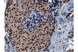 Immunohistochemical staining of paraffin-embedded Adenocarcinoma of Human breast tissue using anti-NT5DC1 mouse monoclonal antibody.