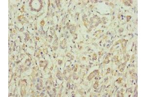 Immunohistochemistry of paraffin-embedded human pancreatic cancer using ABIN7152171 at dilution of 1:100 (Eukaryotic Translation Initiation Factor 3, Subunit M (EIF3M) (AA 1-374) antibody)