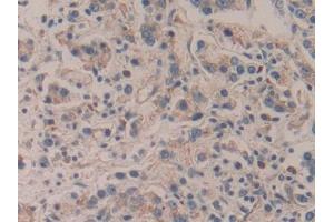 DAB staining on IHC-P; Samples: Human Prostate cancer Tissue (APBA2 antibody  (AA 459-722))