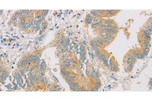 Immunohistochemistry of paraffin-embedded Human colon cancer tissue using ZWINT Polyclonal Antibody at dilution 1:50 (ZWINT antibody)