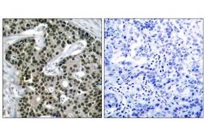 Immunohistochemical analysis of paraffin-embedded human breast carcinoma tissue using HSF1 (phospho- Ser303) antibody (E011263). (HSF1 antibody  (pSer303))