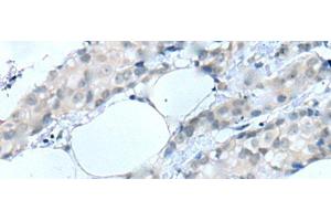 Immunohistochemistry of paraffin-embedded Human breast cancer tissue using MOG Polyclonal Antibody at dilution of 1:25(x200) (MOG antibody)