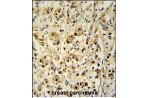 SGP Antibody (Center) (ABIN651464 and ABIN2840255) immunohistochemistry analysis in forlin fixed and paraffin embedded hun breast carcino followed by peroxidase conjugation of the secondary antibody and DAB staining. (SMAGP antibody  (AA 46-75))