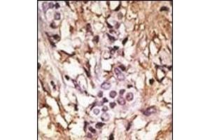 Formalin-fixed and paraffin-embedded human cancer tissue reacted with the primary antibody, which was peroxidase-conjugated to the secondary antibody, followed by DAB staining. (MAP1LC3A antibody  (C-Term))