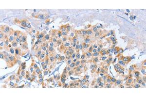 Immunohistochemistry of paraffin-embedded Human breast cancer using APOBEC3D Polyclonal Antibody at dilution of 1:80 (APOBEC3D antibody)
