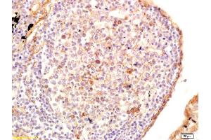 Formalin-fixed and paraffin embedded human lung carcinoma labeled with Anti-GRK6 Polyclonal Antibody, Unconjugated (ABIN1387719) at 1:200 followed by conjugation to the secondary antibody and DAB staining. (GRK4/GRK5/GRK6 (AA 181-280) antibody)