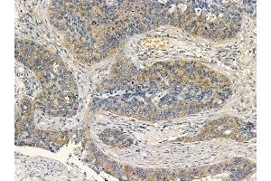 Phospho-Ezrin (Thr567) Mouse Monoclonal Antibody at 1/100 staining human lung cancer and adjacent non-tumor tissue by IHC-P.