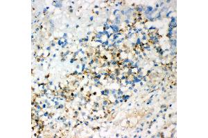 Anti- CD63 Picoband antibody, IHC(P) IHC(P): Human Intestinal Cancer Tissue (CD63 antibody  (AA 97-238))