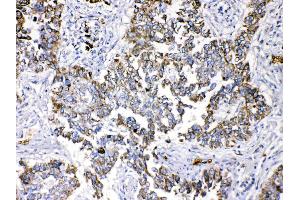 Periplakin was detected in paraffin-embedded sections of human lung cancer tissues using rabbit anti- Periplakin Antigen Affinity purified polyclonal antibody (Catalog # ) at 1 µg/mL.