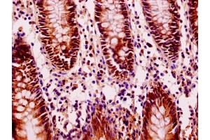 Immunohistochemistry of paraffin-embedded human colon cancer using ABIN7152940 at dilution of 1:100 (FIL1L antibody  (AA 1-200))