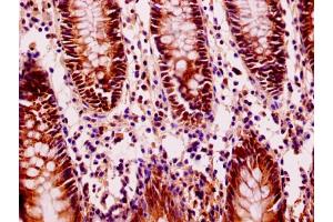 Immunohistochemistry of paraffin-embedded human colon cancer using ABIN7152940 at dilution of 1:100 (FIL1L antibody  (AA 1-200))