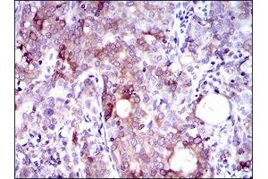 Immunohistochemical analysis of paraffin-embedded cervical cancer tissues using SLC27A5 mouse mAb with DAB staining. (SLC27A5 antibody  (AA 508-570))