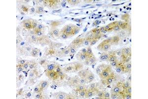 Immunohistochemistry of paraffin-embedded Human liver cancer using RARRES2 Polyclonal Antibody at dilution of 1:200 (40x lens). (Chemerin antibody)