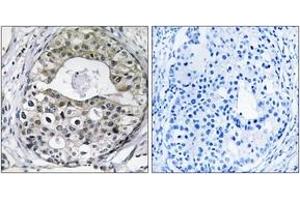 Immunohistochemistry analysis of paraffin-embedded human breast carcinoma tissue, using RPS13 Antibody.