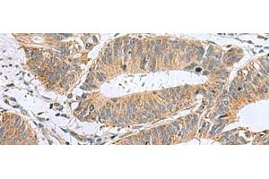 Immunohistochemistry of paraffin-embedded Human colorectal cancer tissue using MARCKSL1 Polyclonal Antibody at dilution of 1:50(x200) (MARCKSL1 antibody)
