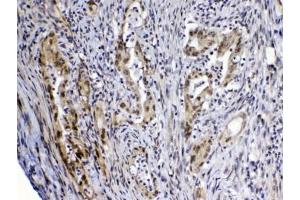 IHC testing of FFPE human rectal cancer tissue with MED4 antibody at 1ug/ml. (MED4 antibody)