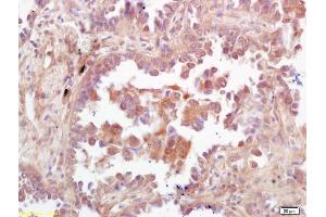 Formalin-fixed and paraffin embedded human lung carcinoma labeled with Rabbit Anti PBK/TOPK Polyclonal Antibody, Unconjugated (ABIN747608) at 1:200 followed by conjugation to the secondary antibody and DAB staining