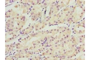 Immunohistochemistry of paraffin-embedded human gastric cancer using ABIN7175738 at dilution of 1:100 (WDR34 antibody  (AA 1-210))