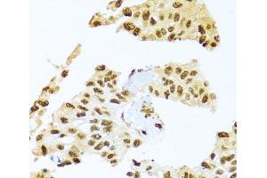 Immunohistochemistry of paraffin-embedded Human lung cancer using SMEK1 Polyclonal Antibody at dilution of 1:100 (40x lens). (SMEK1 antibody)