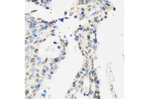 Immunohistochemistry of paraffin-embedded human rectal cancer using CC antibody (ABIN6133528, ABIN6138034, ABIN6138035 and ABIN6222941) at dilution of 1:100 (40x lens). (CCAR2 antibody  (AA 654-923))