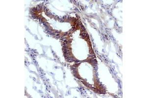 Immunohistochemistry staining (frozen sections) of human tumoral colon epithelium with anti-nitrotyrosine antibody (EM-30). (Nitrotyrosine antibody)