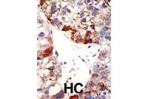 Formalin-fixed and paraffin-embedded human hepatocellular carcinoma tissue reacted with NUB1 polyclonal antibody  , which was peroxidase-conjugated to the secondary antibody, followed by DAB staining . (NUB1 antibody  (N-Term))
