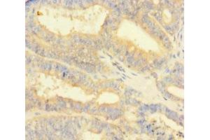 Immunohistochemistry of paraffin-embedded human endometrial cancer using ABIN7165861 at dilution of 1:100 (NIPSNAP3B antibody  (AA 1-247))