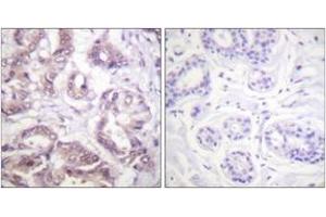 Immunohistochemistry analysis of paraffin-embedded human breast carcinoma tissue, using Survivin (Ab-34) Antibody.