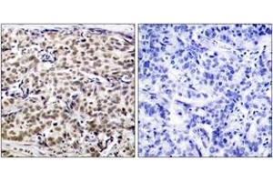 Immunohistochemistry analysis of paraffin-embedded human breast carcinoma tissue, using CREB (Ab-129) Antibody. (CREB1 antibody  (AA 96-145))