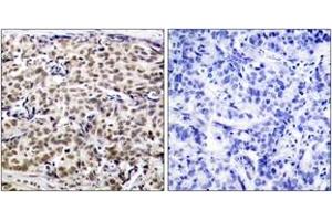 Immunohistochemistry analysis of paraffin-embedded human breast carcinoma tissue, using CREB (Ab-129) Antibody. (CREB1 antibody  (AA 96-145))