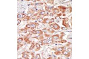 Formalin-fixed and paraffin-embedded human cancer tissue reacted with the primary antibody, which was peroxidase-conjugated to the secondary antibody, followed by DAB staining. (SRPK3 antibody  (Middle Region))