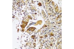 Immunohistochemistry of paraffin-embedded human uterine cancer using CAST antibody  at dilution of 1:100 (40x lens). (Calpastatin antibody  (AA 1-350))