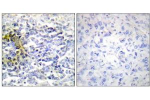 Immunohistochemistry analysis of paraffin-embedded human lung carcinoma tissue using FXR2 antibody. (FXR2 antibody  (C-Term))