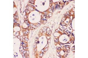 Anti-MyD88 Picoband antibody,  IHC(P): Human Intestinal Cancer Tissue (MYD88 antibody  (AA 44-264))