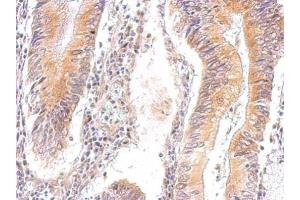 IHC-P Image AMPK gamma 2 antibody detects PRKAG2 protein at cytosol on human gastric cancer by immunohistochemical analysis. (PRKAG2 antibody  (full length))