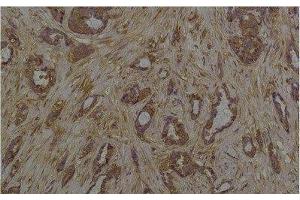 Immunohistochemistry of paraffin-embedded Human breast carcinoma tissue with Phosphoserine Monoclonal Antibody at dilution of 1:200 (Phosphoserine antibody)