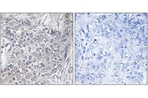 Immunohistochemistry analysis of paraffin-embedded human breast carcinoma, using 4E-BP1 (Phospho-Thr45) Antibody. (eIF4EBP1 antibody  (pThr46))
