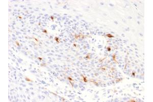 Formalin-fixed, paraffin-embedded human Basal Cell Carcinoma stained with TYRP1 Recombinant Rabbit Monoclonal Antibody (TYRP1/2340R). (Recombinant Tyrosinase-Related Protein 1 antibody  (AA 257-377))