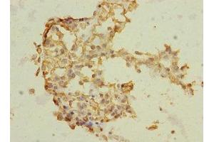 Immunohistochemistry of paraffin-embedded human breast cancer using ABIN7172186 at dilution of 1:100 (TRHDE antibody  (AA 62-200))