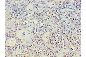Immunohistochemistry of paraffin-embedded human breast cancer using ABIN7149353 at dilution of 1:100