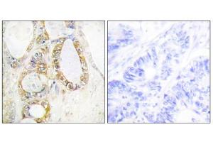 Immunohistochemistry analysis of paraffin-embedded human colon carcinoma tissue using Mucin 13 antibody. (MUC13 antibody  (C-Term))