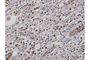 IHC-P Image Immunohistochemical analysis of paraffin-embedded human gastric cancer, using EAR2 , antibody at 1:100 dilution. (NR2F6 antibody  (C-Term))