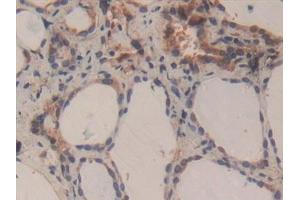 Detection of CASP3 in Human Thyroid Tissue using Polyclonal Antibody to Caspase 3 (CASP3) (Caspase 3 antibody  (AA 29-175))