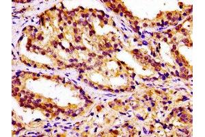IHC image of ABIN7146424 diluted at 1:100 and staining in paraffin-embedded human prostate cancer performed on a Leica BondTM system. (CAMKK2 antibody  (AA 5-148))
