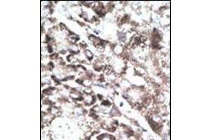 Formalin-fixed and paraffin-embedded human cancer tissue reacted with the primary antibody, which was peroxidase-conjugated to the secondary antibody, followed by DAB staining. (GPR37 antibody  (C-Term))